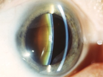 Fortgeschrittene Cataract