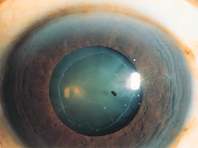 Frühform Cataract